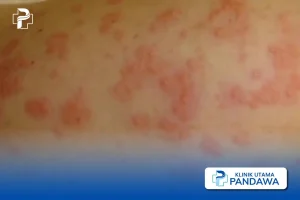 Dampak Kulit Gatal Jika Tidak Ditangani: Mengungkap Konsekuensi yang Lebih Serius