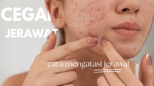 Kebiasaan Sehari-hari Penyebab Jerawat: Mengungkap Pemicu Tersembunyi di Balik Kulit Bersih