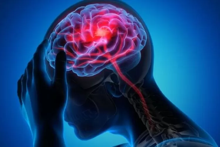 Memahami Perbedaan Stroke Ringan Dan Serius Panduan Lengkap
