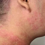 Penyebab Eksim dan Cara Mencegahnya: Panduan Lengkap untuk Kulit Sehat