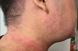 Penyebab Eksim dan Cara Mencegahnya: Panduan Lengkap untuk Kulit Sehat